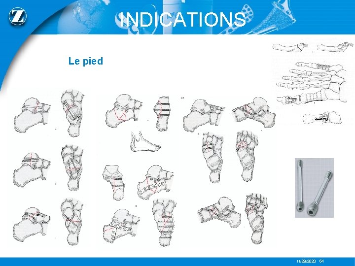INDICATIONS Le pied 11/28/2020 54 