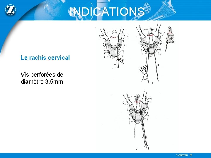 INDICATIONS Le rachis cervical Vis perforées de diamètre 3. 5 mm 11/28/2020 55 