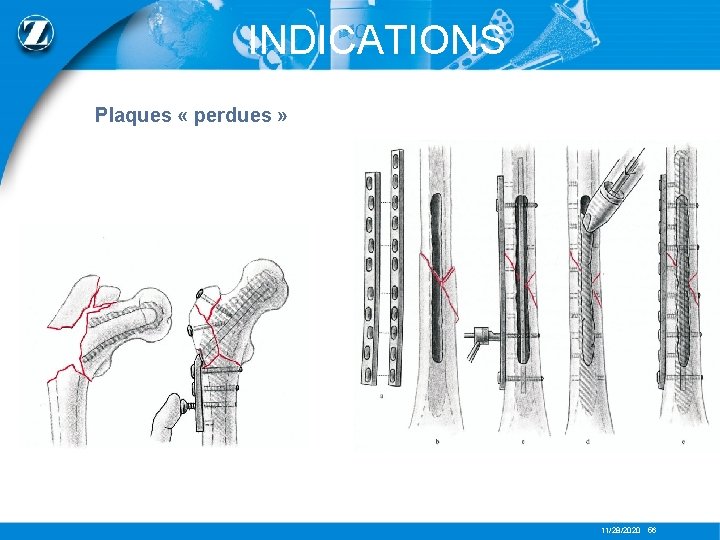 INDICATIONS Plaques « perdues » 11/28/2020 56 