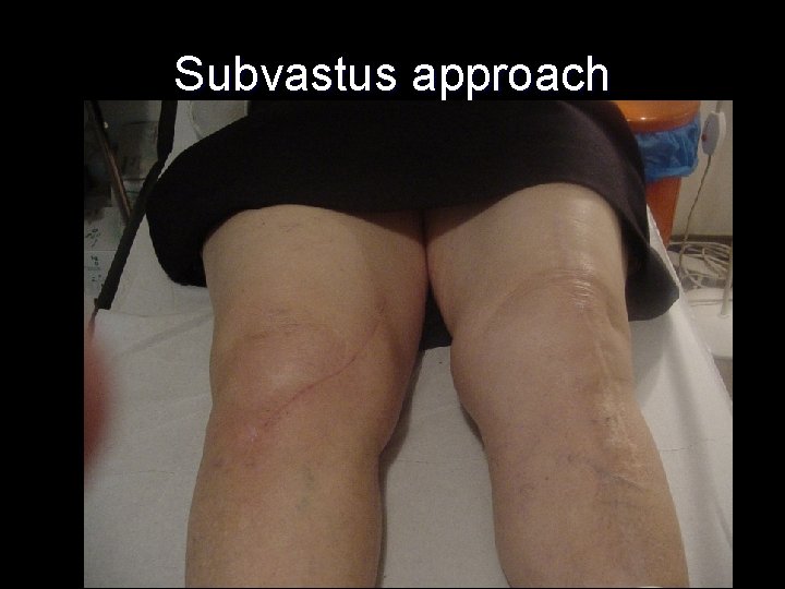 Subvastus approach 