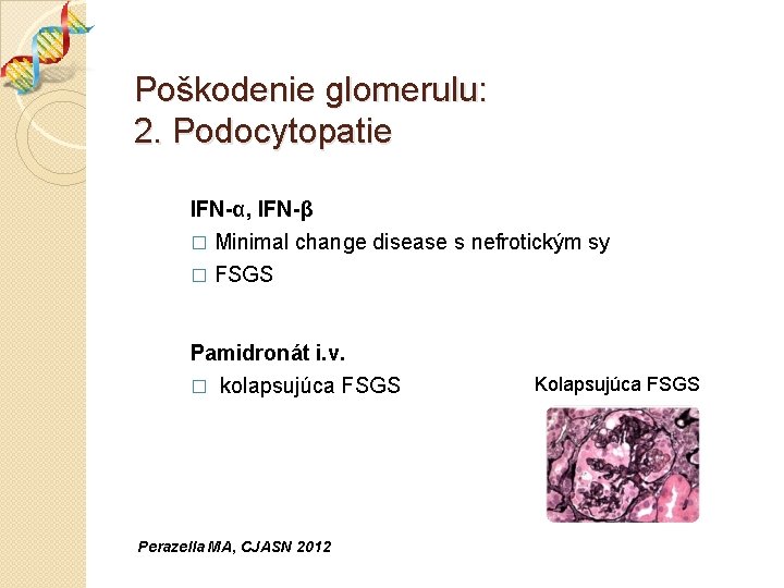 Poškodenie glomerulu: 2. Podocytopatie IFN-α, IFN-β � Minimal change disease s nefrotickým sy �