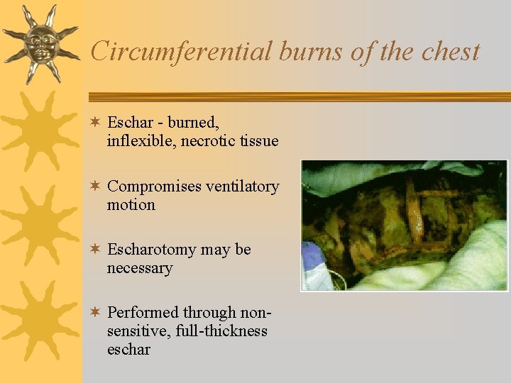 Circumferential burns of the chest ¬ Eschar - burned, inflexible, necrotic tissue ¬ Compromises