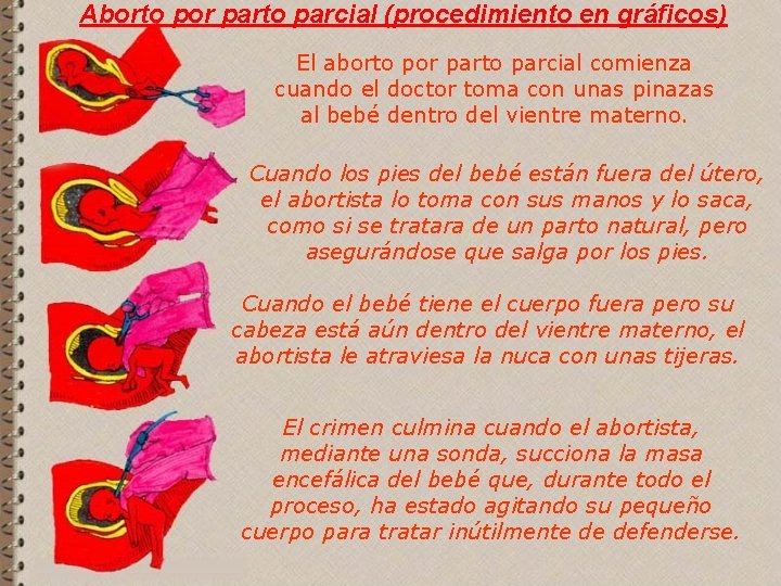 Aborto por parto parcial (procedimiento en gráficos) El aborto por parto parcial comienza cuando