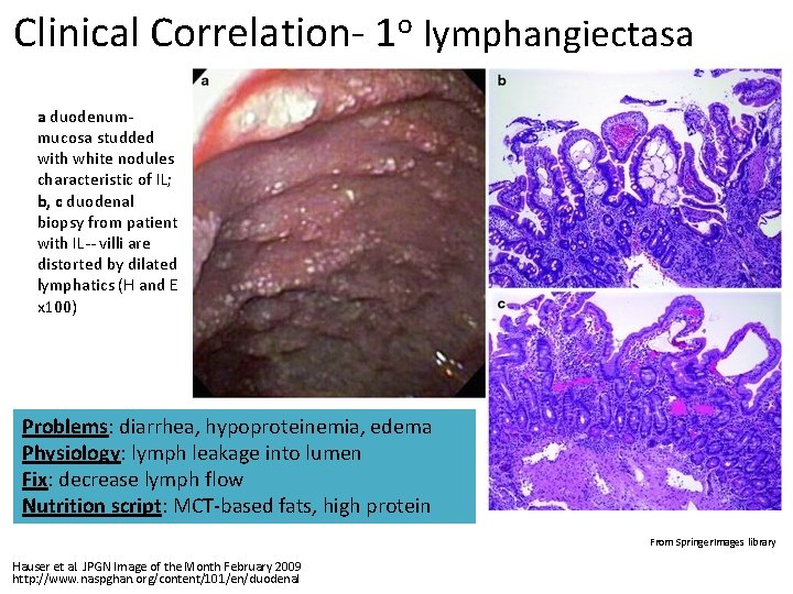 Clinical Correlation- 1 o lymphangiectasa a duodenum- mucosa studded with white nodules characteristic of