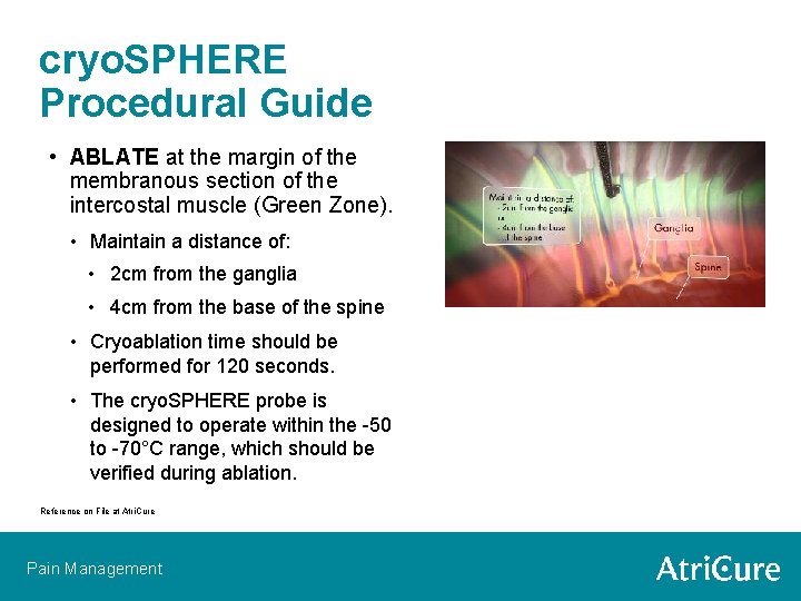 cryo. SPHERE Procedural Guide • ABLATE at the margin of the membranous section of