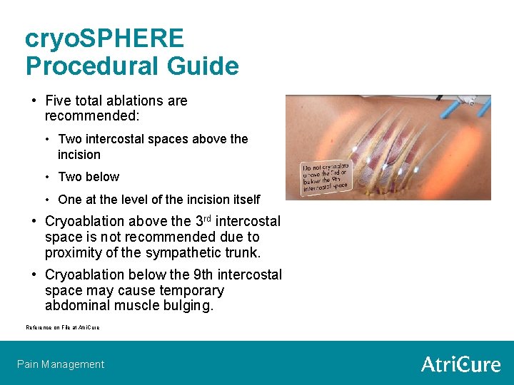 cryo. SPHERE Procedural Guide • Five total ablations are recommended: • Two intercostal spaces