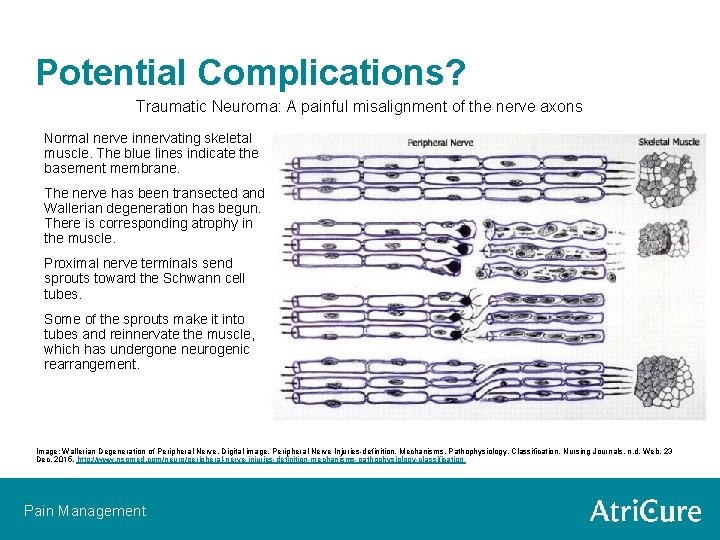 Potential Complications? Traumatic Neuroma: A painful misalignment of the nerve axons Normal nerve innervating