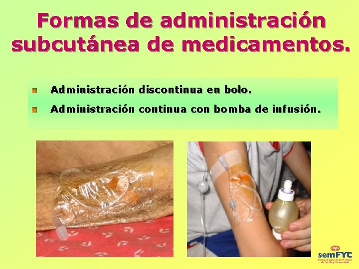 Formas de administración subcutánea de medicamentos. Administración discontinua en bolo. Administración continua con bomba