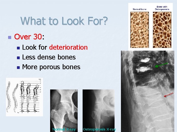 What to Look For? n Over 30: Look for deterioration n Less dense bones