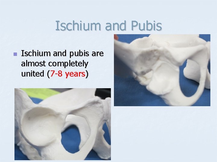 Ischium and Pubis n Ischium and pubis are almost completely united (7 -8 years)