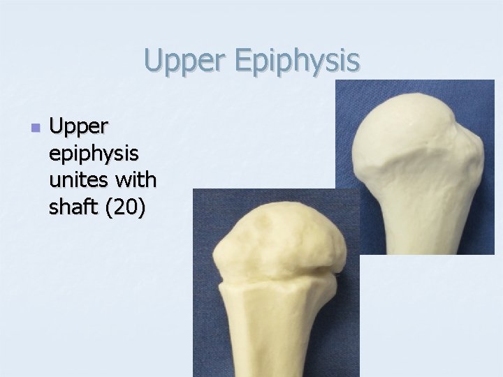 Upper Epiphysis n Upper epiphysis unites with shaft (20) 