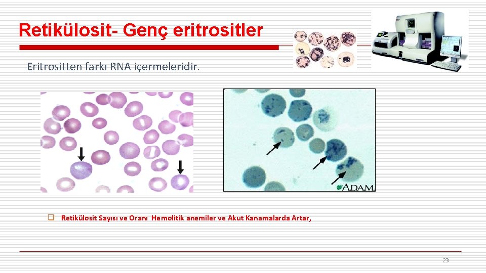 Retikülosit- Genç eritrositler Eritrositten farkı RNA içermeleridir. q Retikülosit Sayısı ve Oranı Hemolitik anemiler