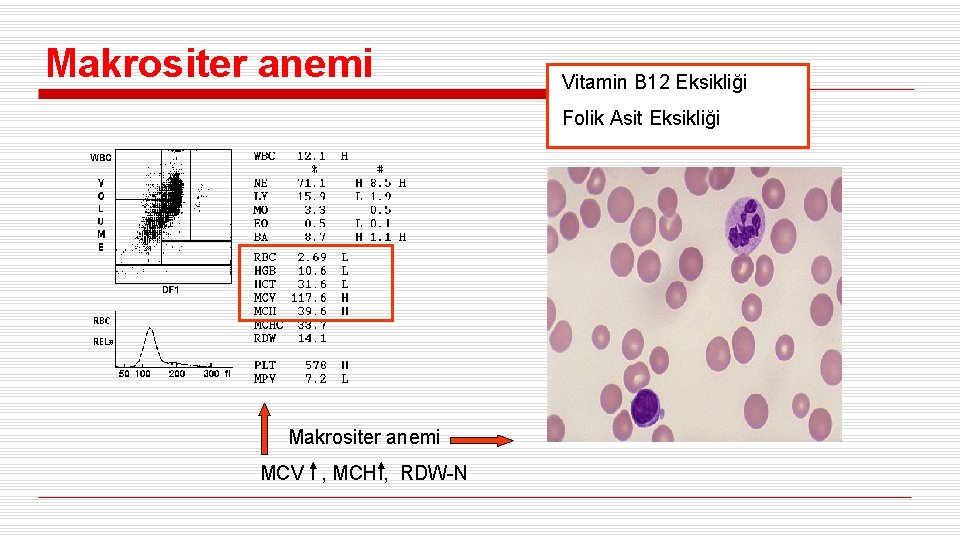 Makrositer anemi Vitamin B 12 Eksikliği Folik Asit Eksikliği Makrositer anemi MCV , MCH