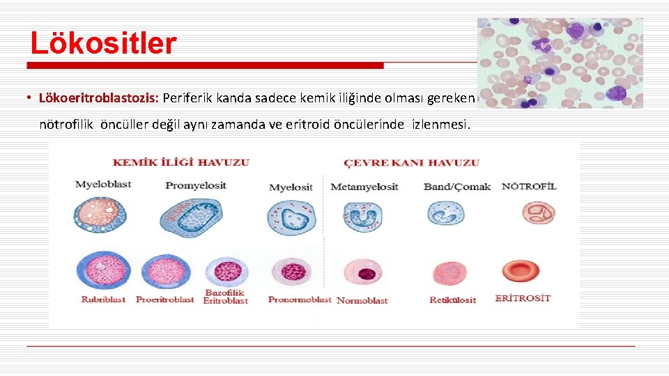 Lökositler • Lökoeritroblastozis: Periferik kanda sadece kemik iliğinde olması gereken erken nötrofilik öncüller değil