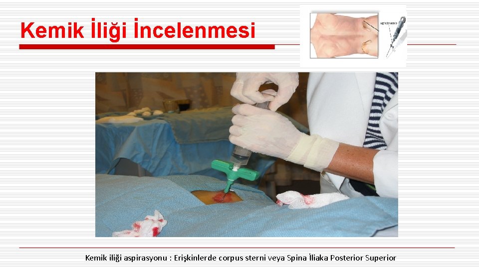 Kemik İliği İncelenmesi Kemik iliği aspirasyonu : Erişkinlerde corpus sterni veya Spina İliaka Posterior