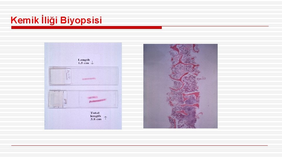 Kemik İliği Biyopsisi 