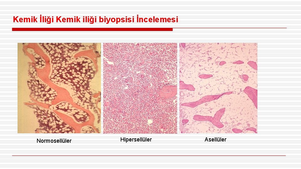 Kemik İliği Kemik iliği biyopsisi İncelemesi Normosellüler Hipersellüler Asellüler 