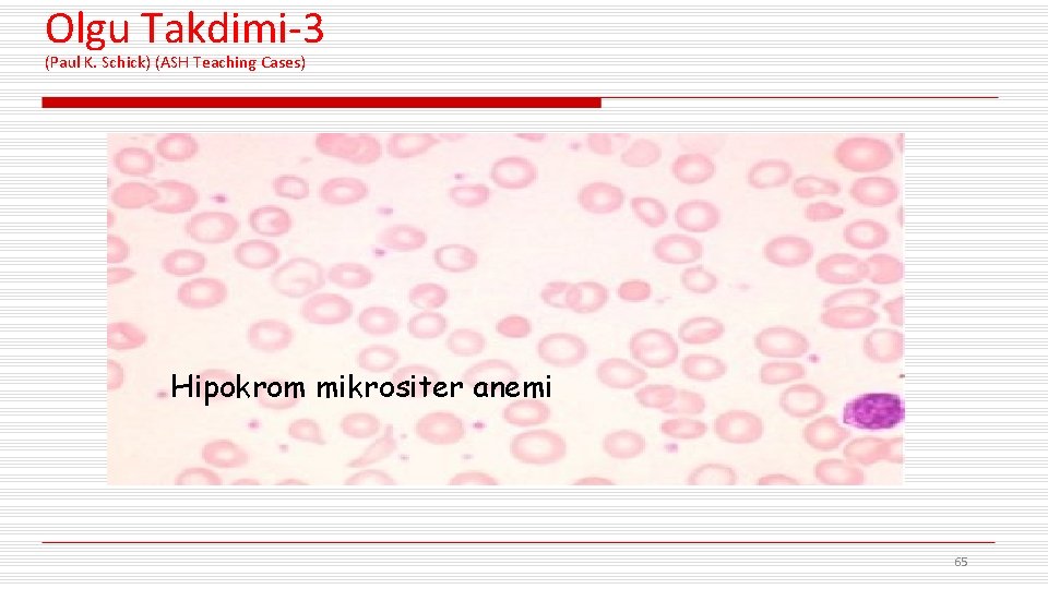 Olgu Takdimi-3 (Paul K. Schick) (ASH Teaching Cases) Hipokrom mikrositer anemi 65 