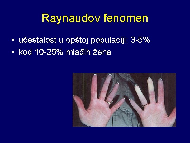 Raynaudov fenomen • učestalost u opštoj populaciji: 3 -5% • kod 10 -25% mlađih