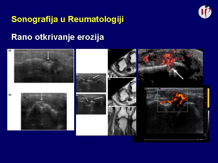 Sonografija u Reumatologiji Rano otkrivanje erozija 