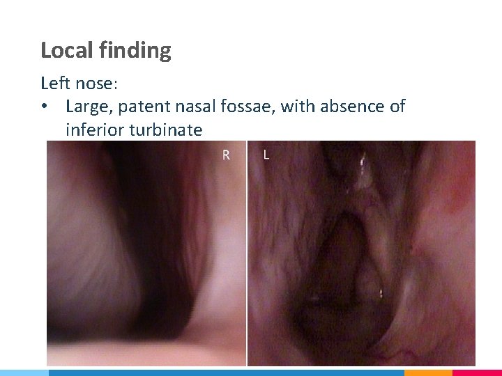 Local finding Left nose: • Large, patent nasal fossae, with absence of inferior turbinate