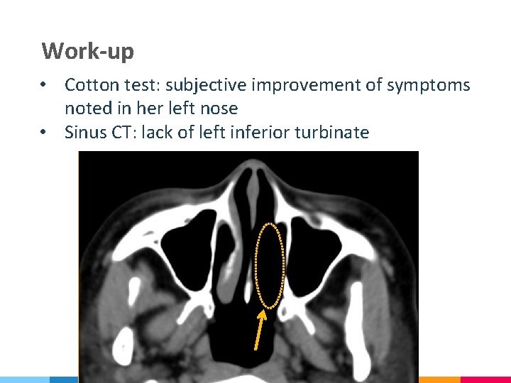 Work-up • Cotton test: subjective improvement of symptoms noted in her left nose •