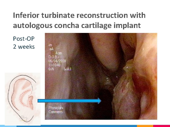 Inferior turbinate reconstruction with autologous concha cartilage implant Post-OP 2 weeks 