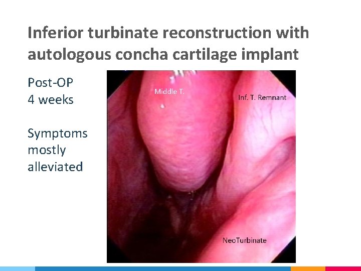 Inferior turbinate reconstruction with autologous concha cartilage implant Post-OP 4 weeks Symptoms mostly alleviated