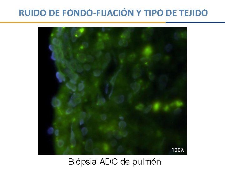 RUIDO DE FONDO-FIJACIÓN Y TIPO DE TEJIDO 100 X Biópsia ADC de pulmón 