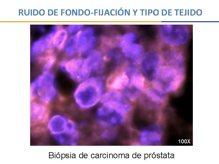 RUIDO DE FONDO-FIJACIÓN Y TIPO DE TEJIDO 100 X Biópsia de carcinoma de próstata