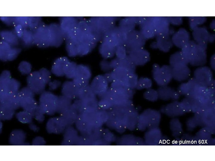 Solapamiento de núcleos ADC de pulmón 60 X 