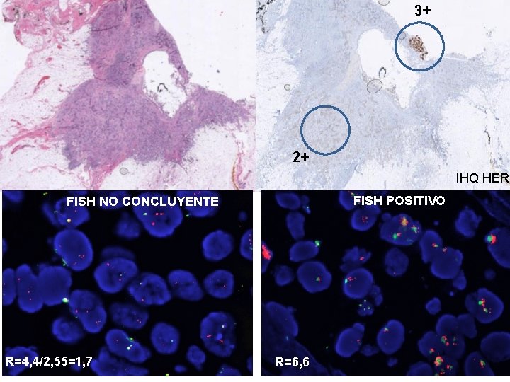 3+ 2+ IHQ HER 2 FISH POSITIVO FISH NO CONCLUYENTE R=4, 4/2, 55=1, 7