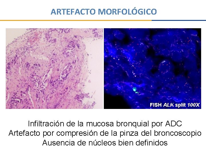 ARTEFACTO MORFOLÓGICO FISH ALK split 100 X Infiltración de la mucosa bronquial por ADC