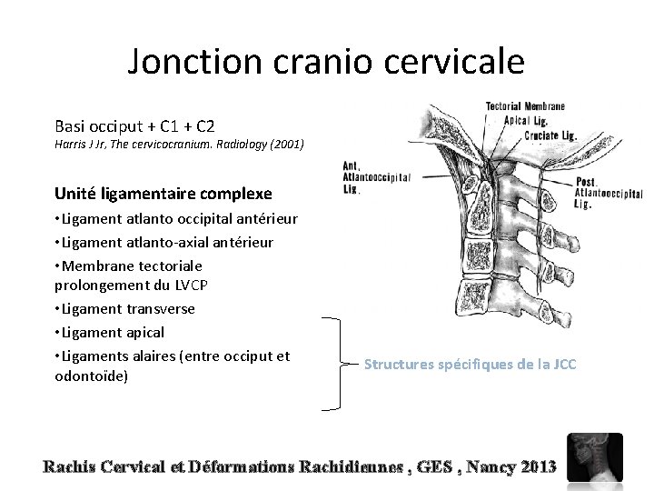 Jonction cranio cervicale Basi occiput + C 1 + C 2 Harris J Jr,