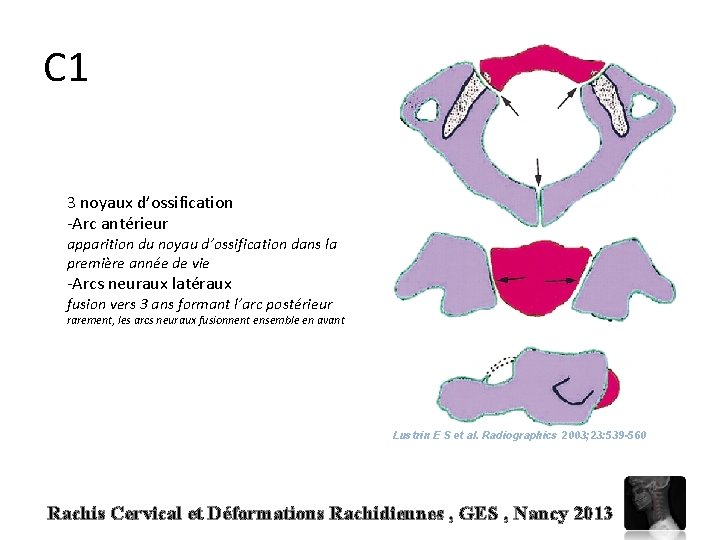 C 1 3 noyaux d’ossification -Arc antérieur apparition du noyau d’ossification dans la première