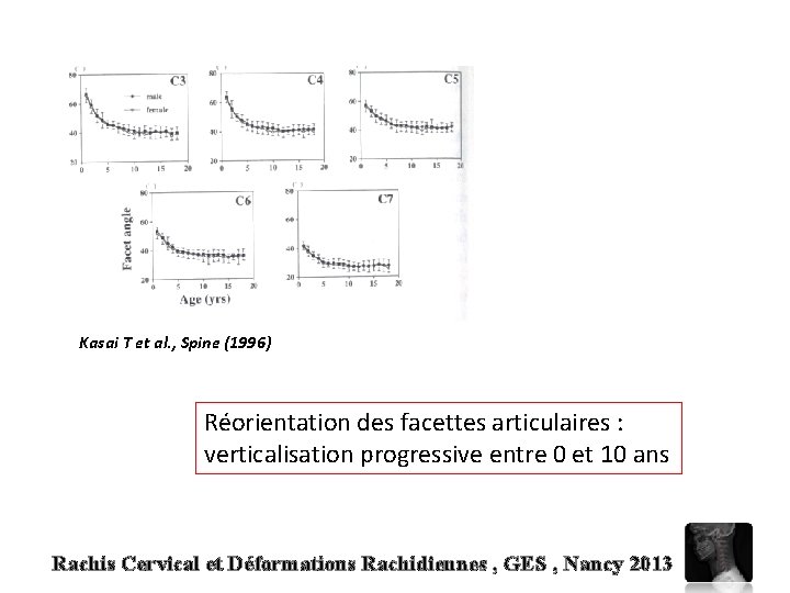 Kasai T et al. , Spine (1996) Réorientation des facettes articulaires : verticalisation progressive