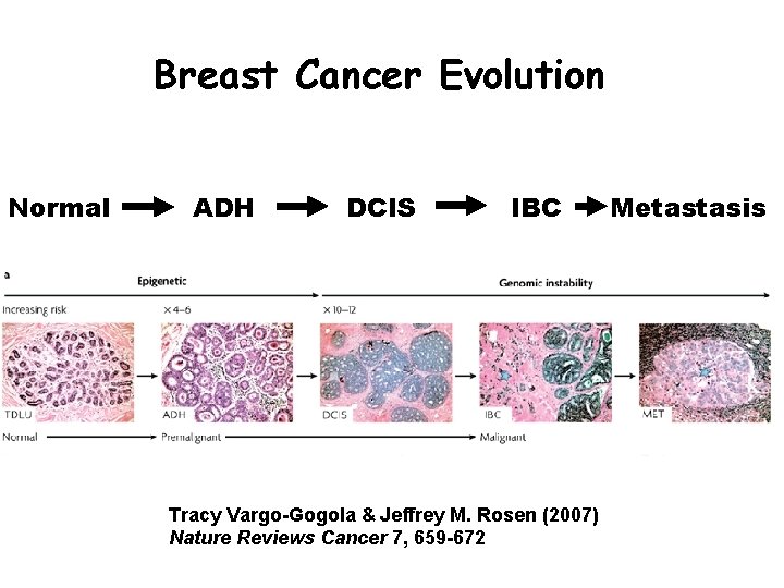 Breast Cancer Evolution Normal ADH DCIS IBC Tracy Vargo-Gogola & Jeffrey M. Rosen (2007)
