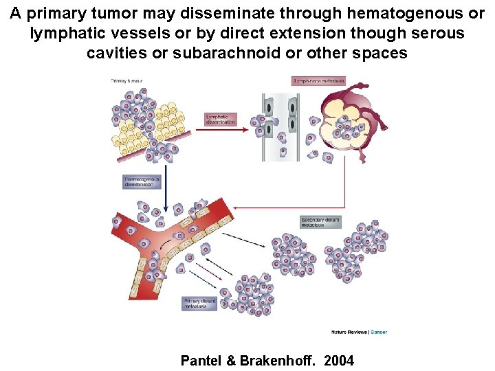 A primary tumor may disseminate through hematogenous or lymphatic vessels or by direct extension