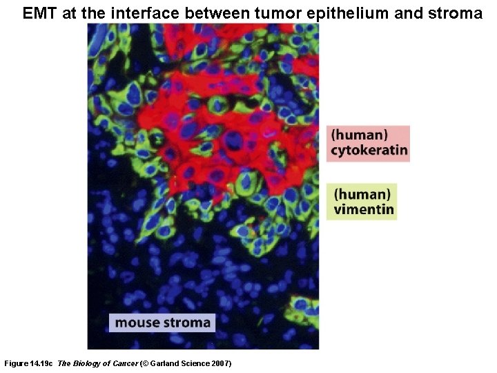 EMT at the interface between tumor epithelium and stroma Figure 14. 19 c The