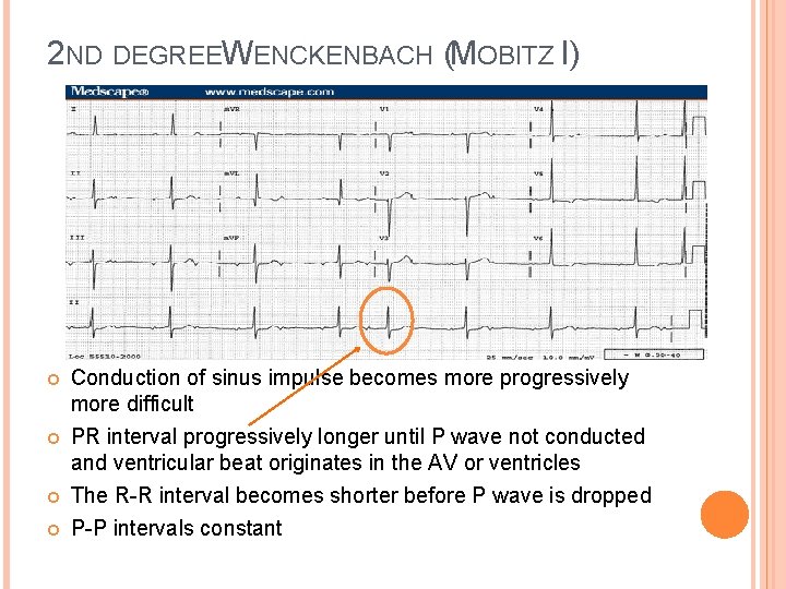 2 ND DEGREEW ENCKENBACH (MOBITZ I) Conduction of sinus impulse becomes more progressively more