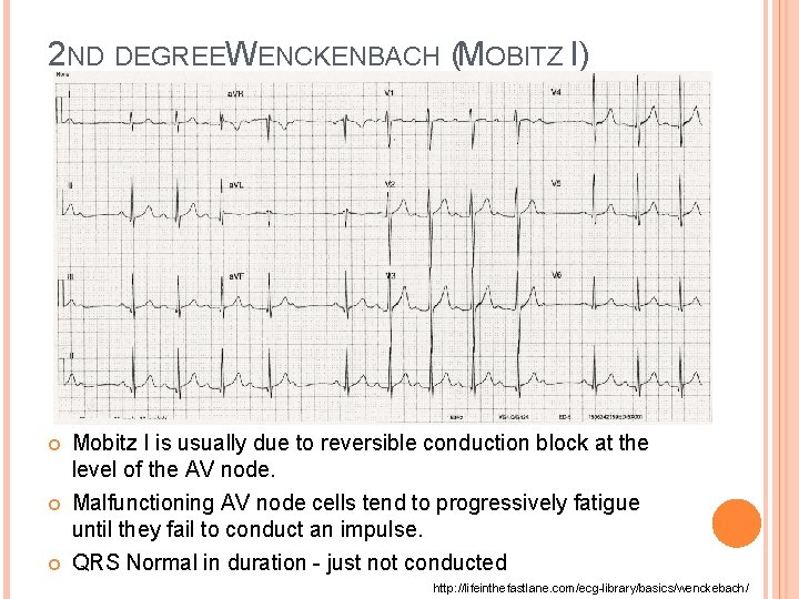 2 ND DEGREEW ENCKENBACH (MOBITZ I) Mobitz I is usually due to reversible conduction