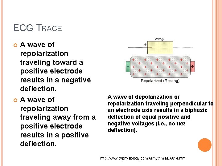 ECG TRACE A wave of repolarization traveling toward a positive electrode results in a