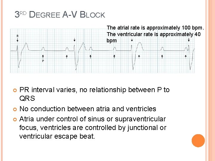 3 RD DEGREE A-V BLOCK The atrial rate is approximately 100 bpm. The ventricular