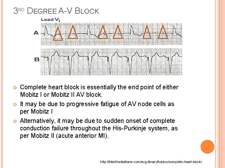 3 RD DEGREE A-V BLOCK Complete heart block is essentially the end point of