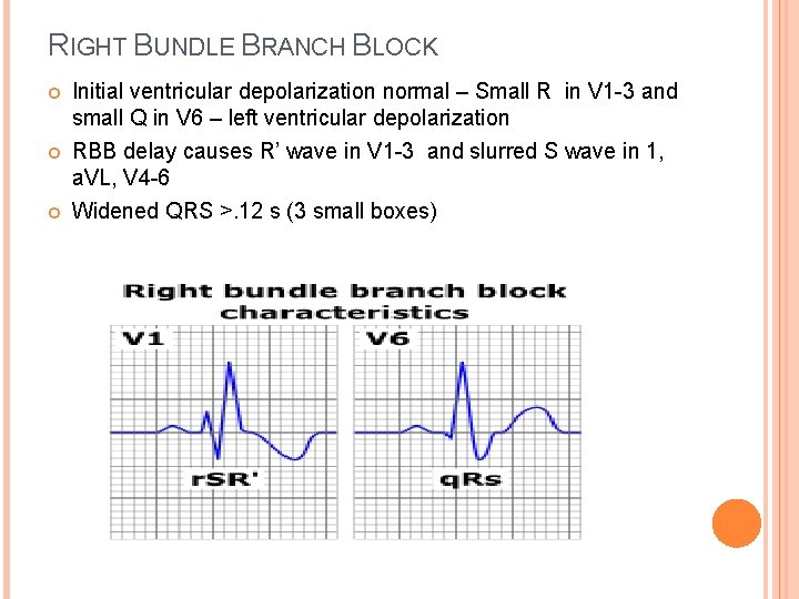 RIGHT BUNDLE BRANCH BLOCK Initial ventricular depolarization normal – Small R in V 1
