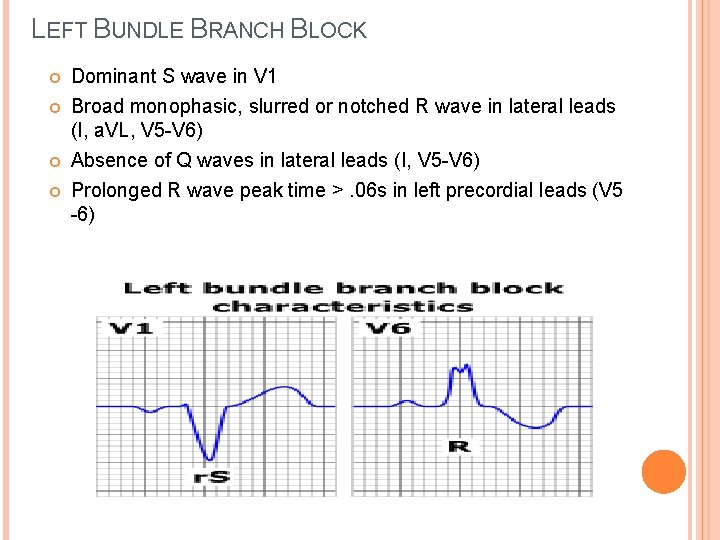 LEFT BUNDLE BRANCH BLOCK Dominant S wave in V 1 Broad monophasic, slurred or