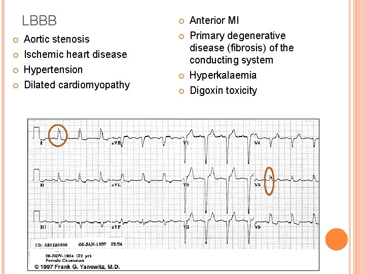 LBBB Aortic stenosis Ischemic heart disease Hypertension Dilated cardiomyopathy Anterior MI Primary degenerative disease