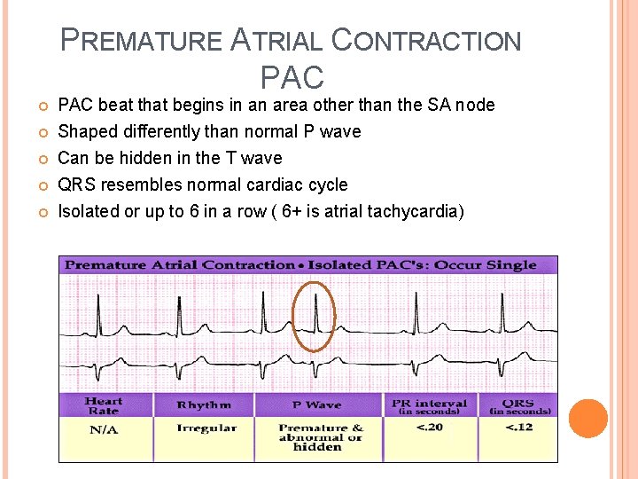 PREMATURE ATRIAL CONTRACTION PAC beat that begins in an area other than the SA