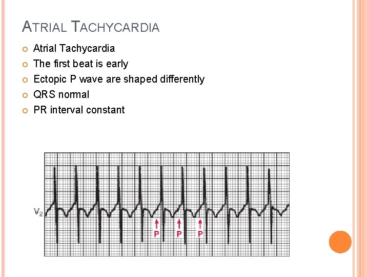 ATRIAL TACHYCARDIA Atrial Tachycardia The first beat is early Ectopic P wave are shaped