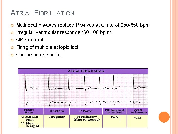 ATRIAL FIBRILLATION Mutlifocal F waves replace P waves at a rate of 350 -650